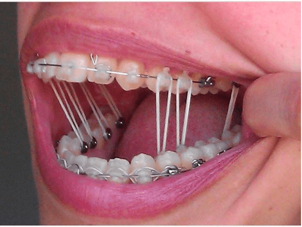 braces rubber bands, changing after every meal