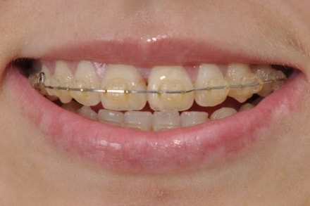 clear braces turn yellow easily