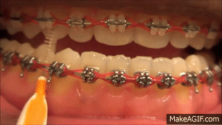 15 Must-Knows About Braces For Potential Metalmouths To 
