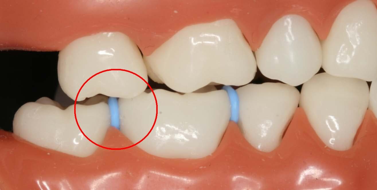 spacers between your teeth for easy extraction of teeth