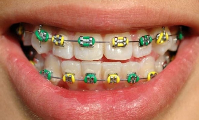 ugly colour combinations for braces