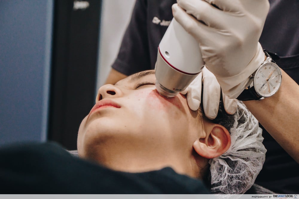 i-tried-acne-scar-removal-in-2019-and-here-s-what-went-down-thesmartlocal