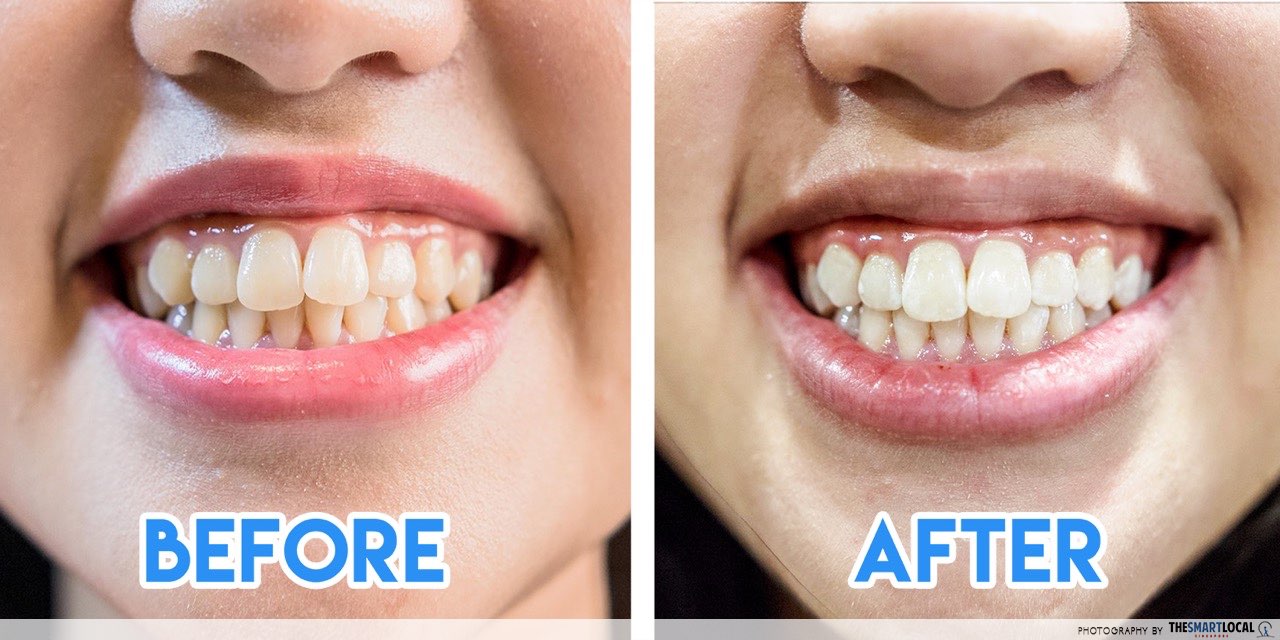 Teeth Whitening Mirage Aesthetic Before After
