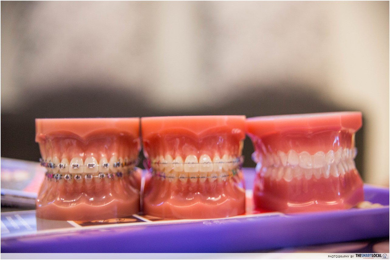 Invisalign braces vs traditional braces