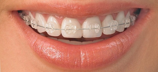 before your clear braces turn yellow