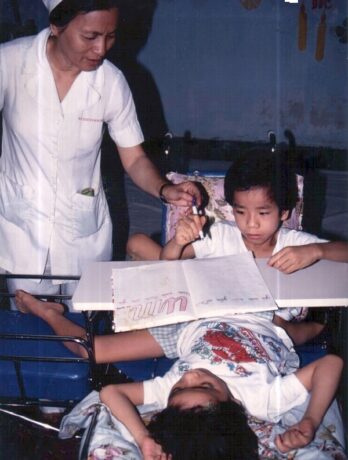 Vietnam's 1988 Conjoined Twins' Separation Surgery Was A Miracle