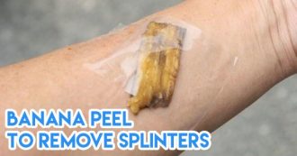 Banana peel to remove splinters
