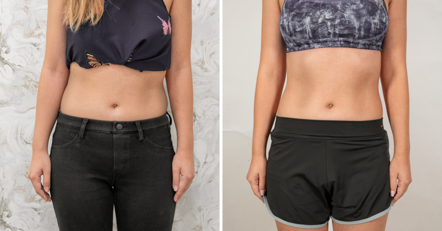 fat freezing before after results