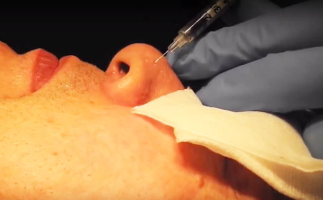 acne scar removal treatment - TCA cross chemical reconstruction