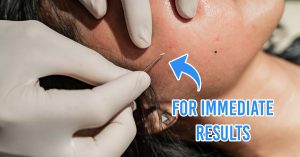 acne scar removal treatment - subcision