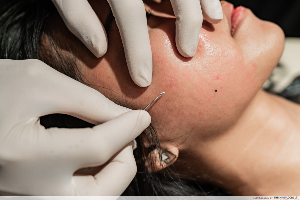 acne scar removal treatment - subcision