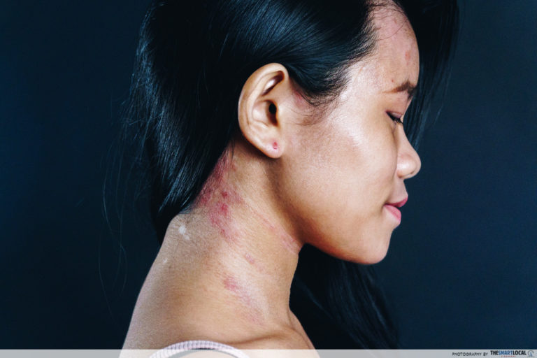 How I Controlled My Sensitive Skin & Eczema In Singapore Under A Month