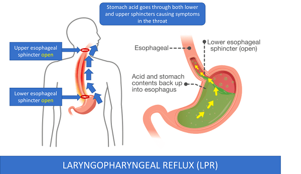 laryngopharyngeal reflux