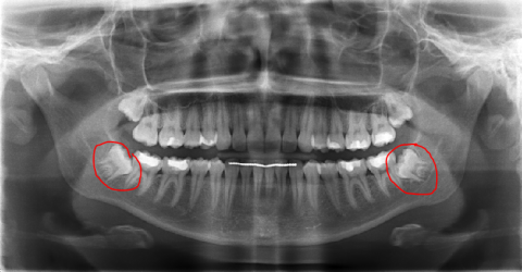 Guide To Wisdom Tooth Removal In Singapore - Extraction, Costs and Recovery