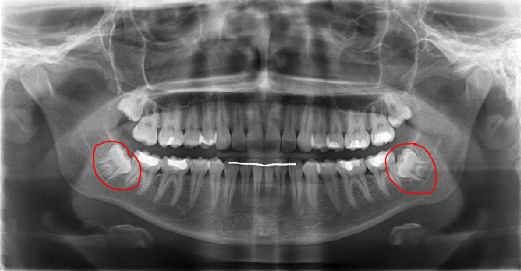 guide to wisdom tooth removal - x-ray of impacted wisdom teeth