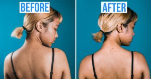 back acne before after