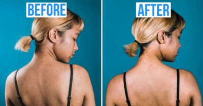 back acne before after