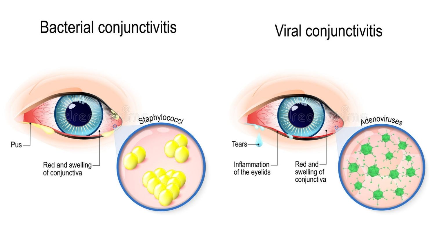 viral conjunctivitis