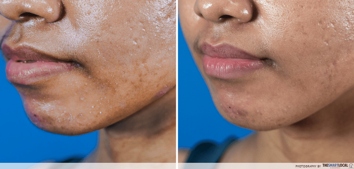 Reducing pimples acne Chin