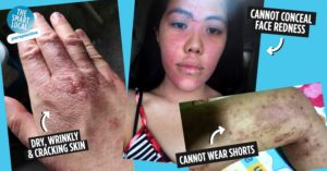Eczema in Singapore