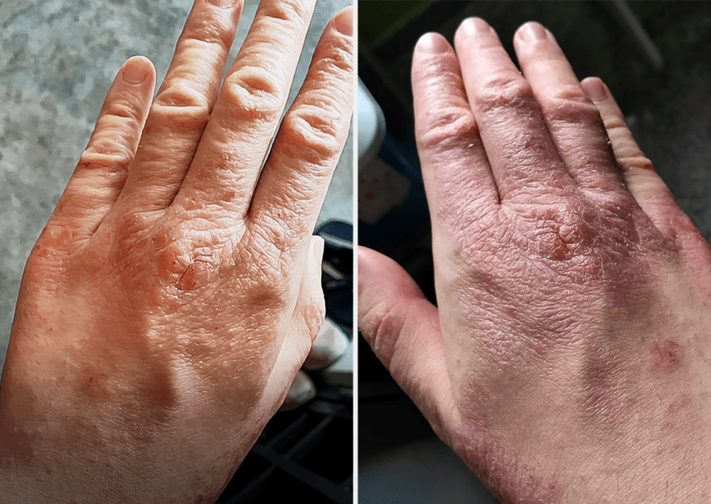 Eczema in Singapore - Hand rashes