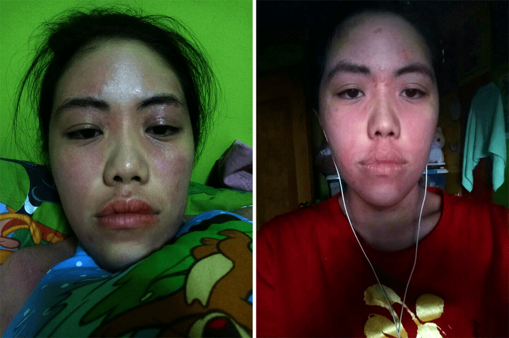 Eczema in Singapore - Bermuda Triangle on Face