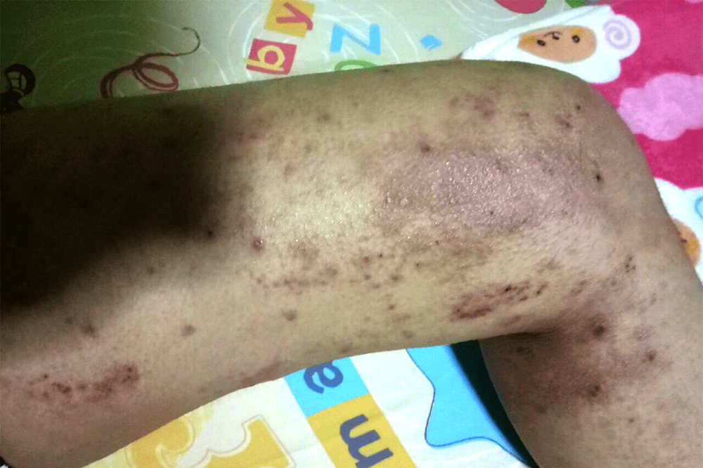 Eczema in Singapore - Leg rashes