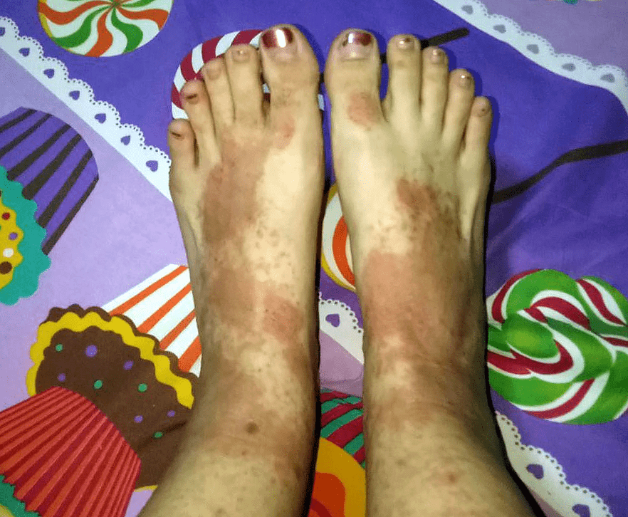 Eczema in Singapore - foot rashes