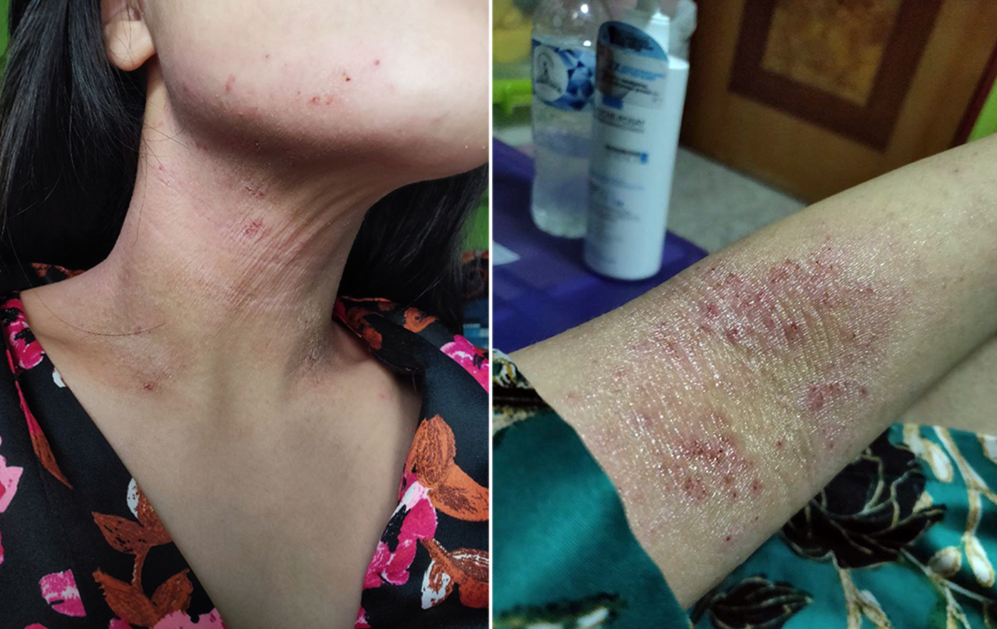 Eczema in Singapore - Neck and Elbow Rash