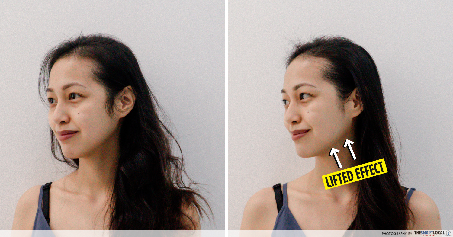 Before and after V-Lift treatment