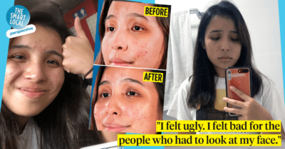 acne treatment product singapore