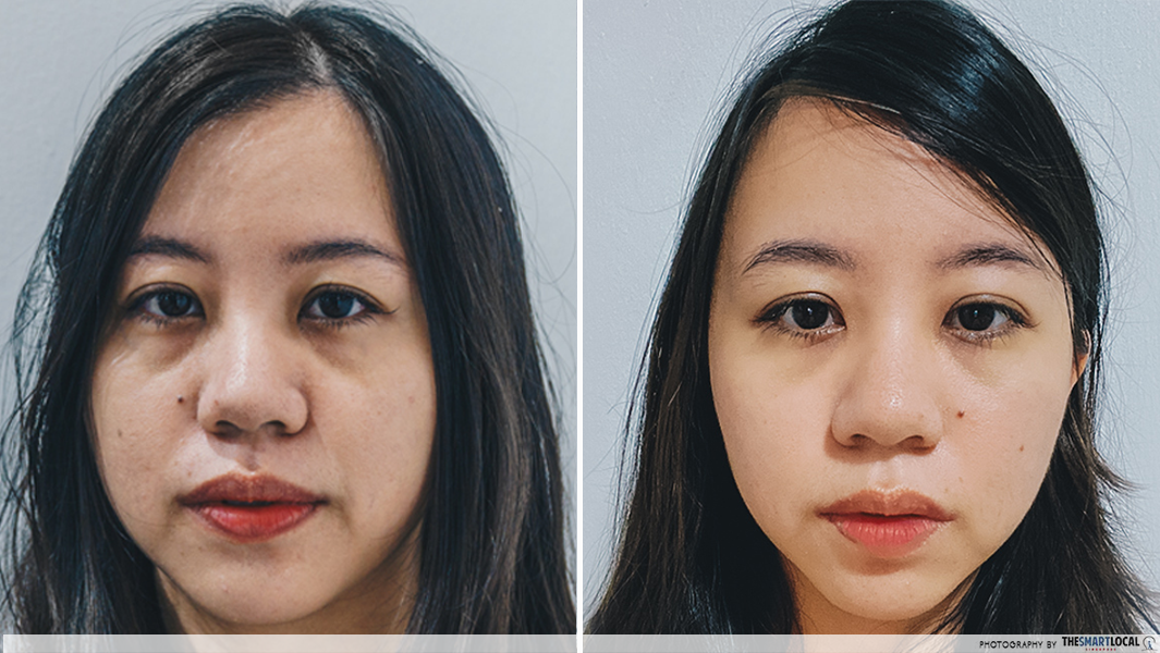 before and after facial acupuncture