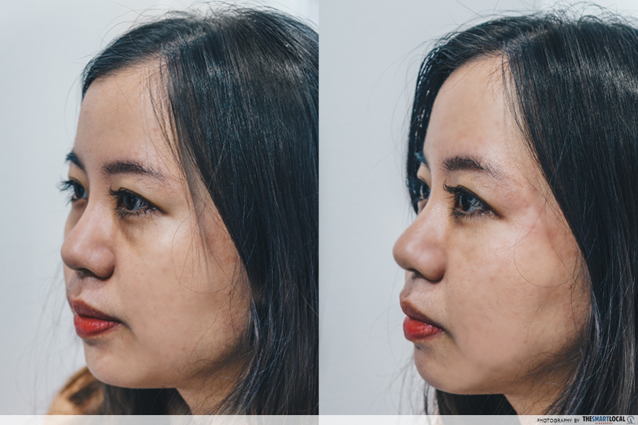 Before and after facial acupuncture