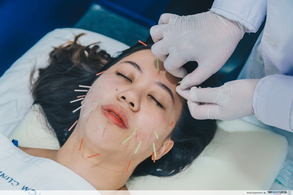 Facial acupuncture at Sin Kang TCM