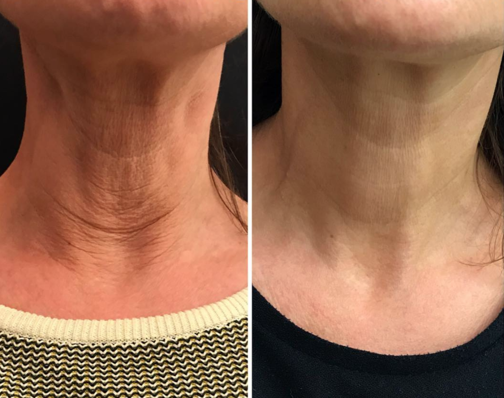 Profhilo Fillers Before And After Neck