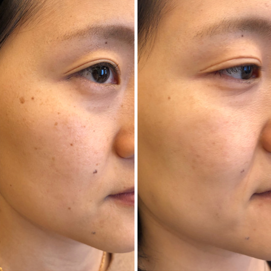HALO Laser Before And After
