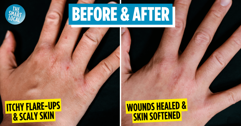 Eczema Care Before & After Results