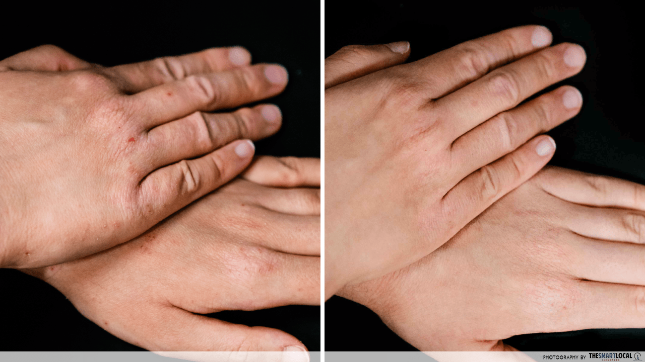Eczema Care Before & After