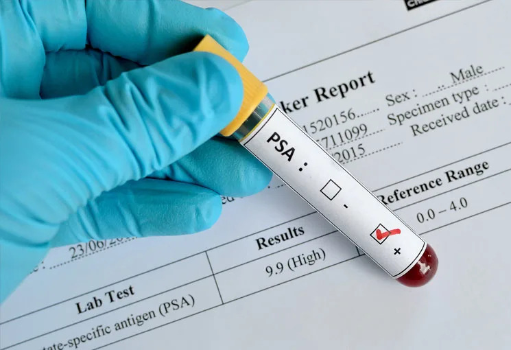 Health Check Ups - blood test to detect prostate cancer 
