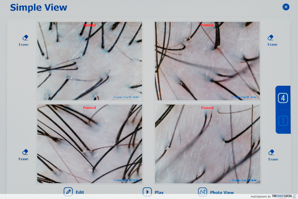 hair care tips - Post-Treatment Scalp Scan Analysis