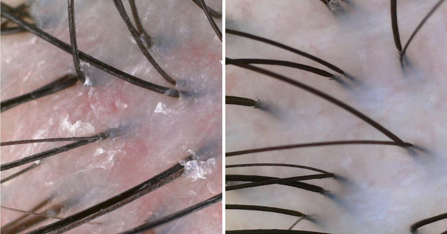 before after scalp treatment