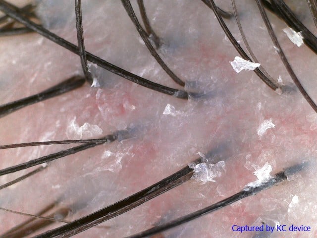 tk trichokare - scalp scan before