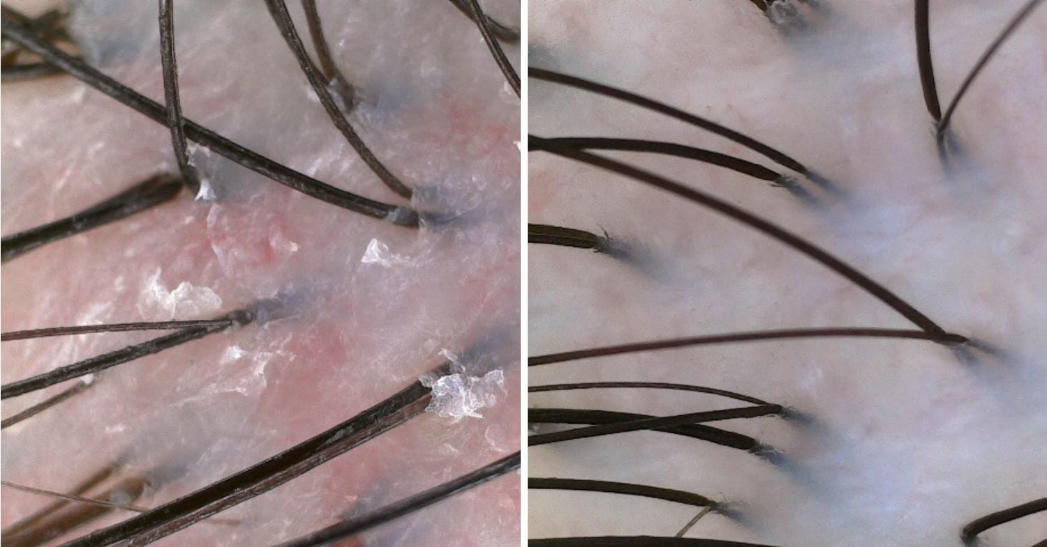 tk trichokare - scalp scans before after