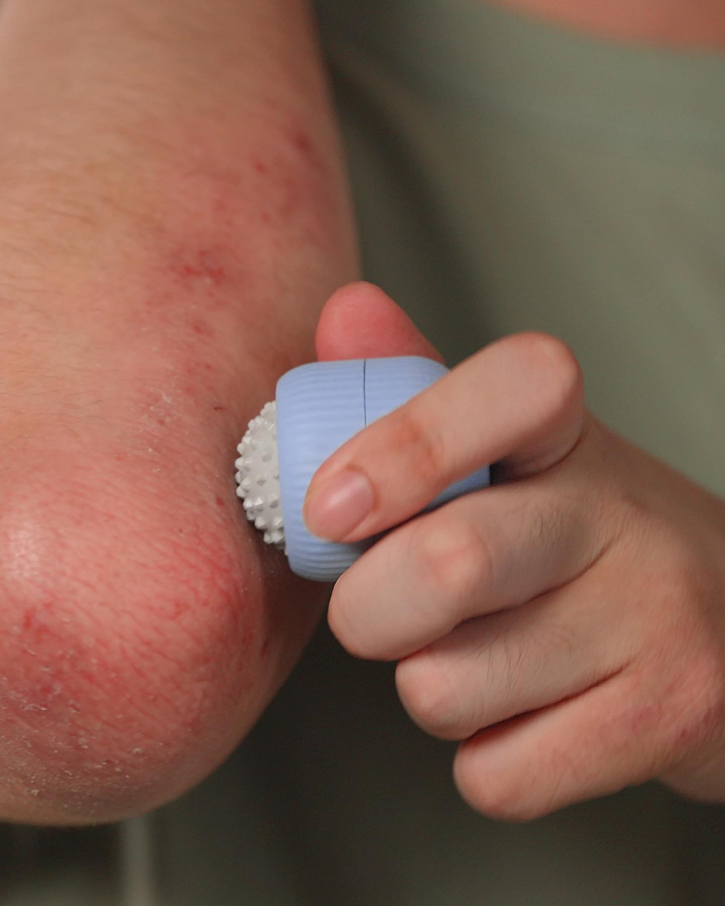 Itch Relief Products Singapore Scratcher