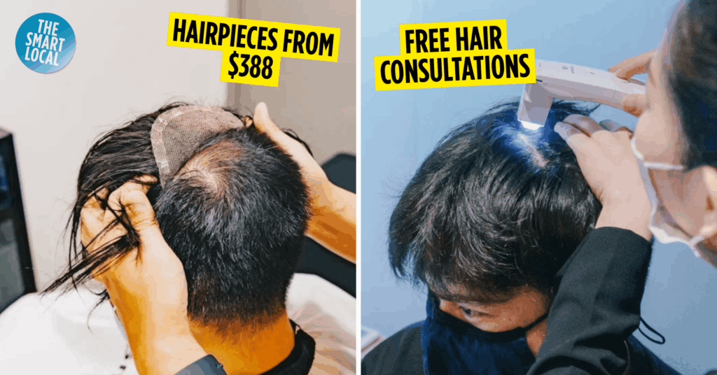 Hair Replacement Services Singapore